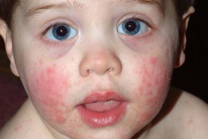 Baby Skin Rash