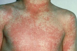 Baby Skin Rash