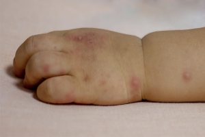 Baby Skin Rash